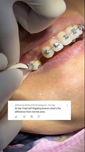 Self-Ligating vs. Traditional Braces: What Are The Differences?