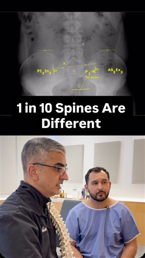 Did you know 1 in 10 people don’t have a ‘normal’ lumbar spine? About 10% of the population has what’s called a transitional vertebra in the lower back, and most people have no idea they have it. Normally, the spine has five movable lumbar vertebrae. But in this group, development happens differently 👇 • Some people have L5 fused to the sacrum → this is called sacralization • Others have S1 acting like an extra lumbar → this is called lumbarization Each pattern changes how the spine moves, how 