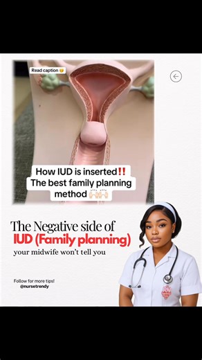 “The bad effects of IUDs they don’t really talk about…” IUDs are very effective, but there are things you should know before choosing one. 1. Pain during insertion Let’s be honest — insertion can be very painful for some women, especially if you’ve never given birth. 2. Heavy bleeding & cramps (especially copper IUD) Periods can become heavier, longer, and more painful in the first few months. 3. Irregular bleeding (hormonal IUD) Spotting or unpredictable periods can last for months. 4. Hormonal
