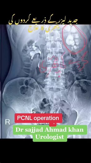 PCNL Operation Explained by Dr. Sajjad Ahmad