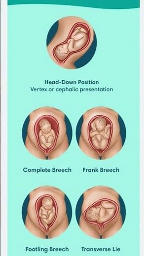 baby POSITION for normal delivery