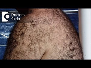What is Hirsutism? - Dr. Harish Prasad B R
