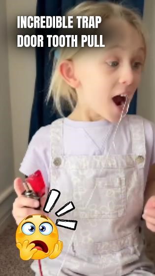 Watch This Incredible Trap Door Tooth Pull in Action