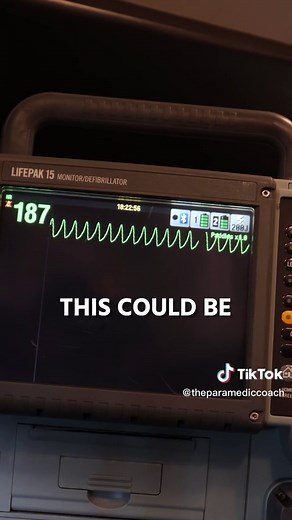 Understanding Ventricular Tachycardia in Emergency Care