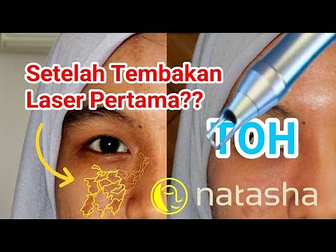 Before-After Laser Birthmark Treatment (Nevus of Ota) | Natasha Skincare Sidoarjo