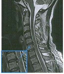 Neck Pain | IDD Therapy Spinal Decompression