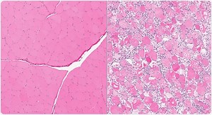 Rhabdomyolysis Non-Physical Causes