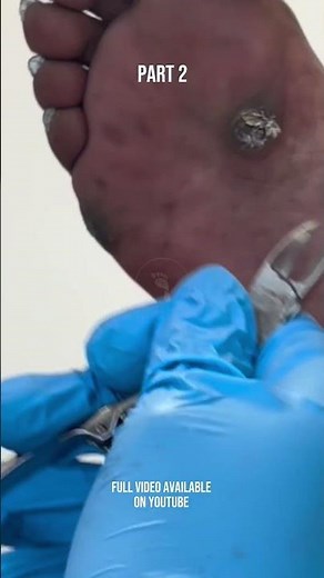 FULL VIDEO AVAILABLE: CORN (IPK) REMOVAL | THEY LOOK LIKE ROCKS! 😱https://youtu.be/Pzh9wwc09wo