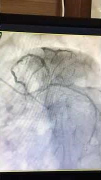 coronary angiography procedure in cath lab hospital 🏥