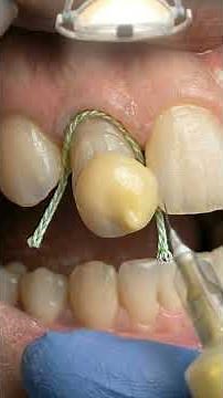 😱 This Crooked Overlapping Tooth Was Straightened Instantly – Watch the Amazing Makeover!