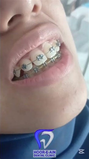 How To Tie an O-Ring #oring #braces #how #howto #shorts #shortsfeed #education #study #orthodontics