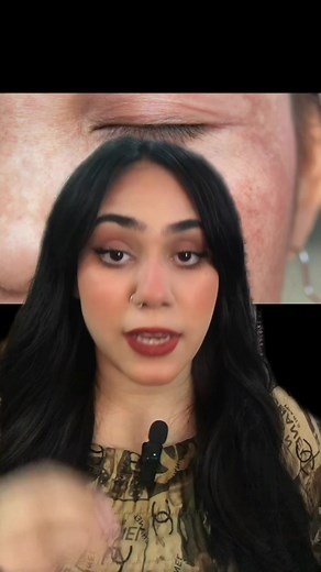 @Skin'Ola_Beauty #skin #brighten #affordable #brightening #kojicacid #malasma