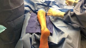 Calf Implants to Correct Asymmetry After Muscle Loss