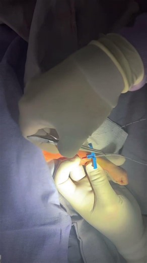 Los que saben instalar catéter PICC #PICC #estudiantedeenfermeria #neonato #pediatria