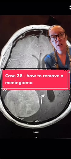 Replying to @hidden_goddess explanation of how we remove a meningioma! A meningioma is a tumor that arises from the meninges — the membranes that surround the brain and spinal cord. Although not technically a brain tumor, it is included in this category because it may compress or squeeze the adjacent brain, nerves and vessels. Meningioma is the most common type of tumor that forms in the head. #neurosurgery #casestudy #sundaycasestudy #ladyspinedoc #brainsurgery #braintumor #trauma #mvc #firstre