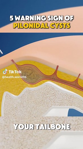 Signs of Pilonidal Cyst: Identify Symptoms Early for Health