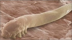 Eye mites: Millions of people have them and don't know it