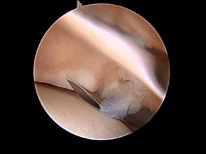 Ankle Arthroscopy after Extensive Debridement SFISM