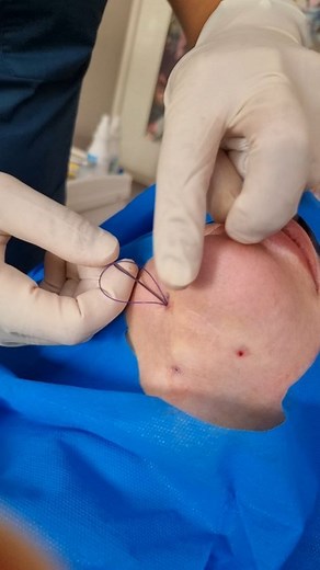 ‎دکتر زناشویی‎ on Instagram‎: ". @iran_skin_facts @iran_skin_academy لیفت با نخ تخصص من است 👨🏻‍⚕️🎙😌 من دکتر حمیدرضا کلانتری هستم و با تجربه حاصل از انجام هزاران لیفت با نخ برای نواحی مختلف بدن مثل صورت و گردن و غبغب و بازو و ابرو و ... می توانم پاسخگوی سوالات شما در رابطه با این روش جذاب در صفحه خودم باشم📲👨🏻‍⚕️📲 فالورهای عزیزم تا پایان هفته می توانند از این تخفیف های ویژه میلیون تومانی برای لیفت با نخ، تزریق پروفایلو و اِل پی آر پی استفاده کنند و لذت ببرند🎊🎊🎊 @iran_skin_academy 📲۰۹۱۹