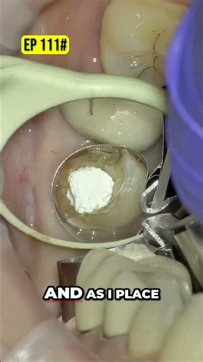 Dentistry Matrix Band Technique Easy Step by Step Guide