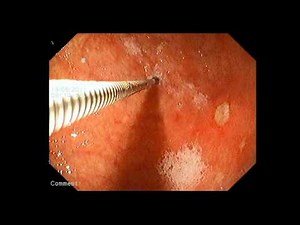 Эндоскопия пищевода и желудка.mpg