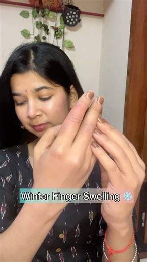 Winter Finger Swelling Treatment ❄️ | Fingers Soojna Home Remedies | Chillblains Relief ✨