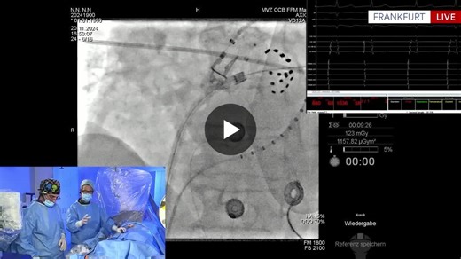 Pulmonary Vein Isolation Using the FARAPULSE System  Operator: K. R. Julian Chun  A 76-year-old male with persistent atrial fibrillation undergoes pulmonary vein isolation using…