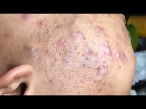 Tokyo Acne Treatment Blackhead Extractions Popping | HaiAu #53