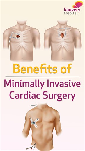Heart surgery doesn’t have to mean long hospital stays and painful recovery. In this video, Dr. Arunkumar Krishnasamy, Senior Consultant – Cardiothoracic Surgery, Kauvery Hospital Alwarpet, explains how modern techniques with smaller incisions and advanced care help patients heal faster and safely. #KauveryHospital #KauveryHospitalChennai #KauveryHospitalAlwarpet #HeartSurgery #CardiacCare #CardiothoracicSurgery #HeartHealth #FasterRecovery #ModernMedicine #MinimallyInvasiveSurgery #PatientCare 