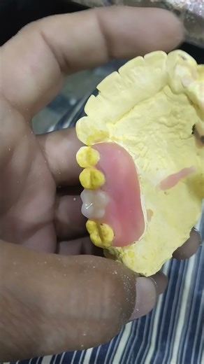 Single Unit Flexible Removable Partial Denture Ready for Flasking 😁😁😁#dentalprosthesis #viralvideo