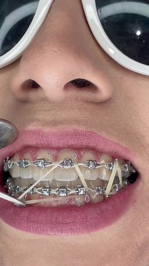 Quick Braces Removal Tips for Faster Results