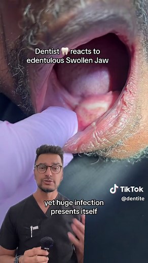 Abscessed Jaw: Causes, Symptoms, and Treatment Options