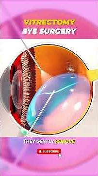 Vitrectomy Eye Surgery Explained | 3D Animation of Retinal Procedure #facts #medicalshorts