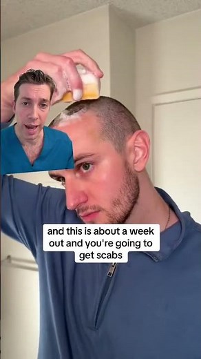 Post-Washing Your Scalp After a Hair Transplant