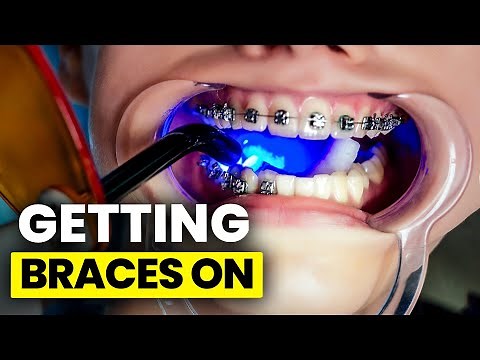 Getting Braces Put On - Full Process
