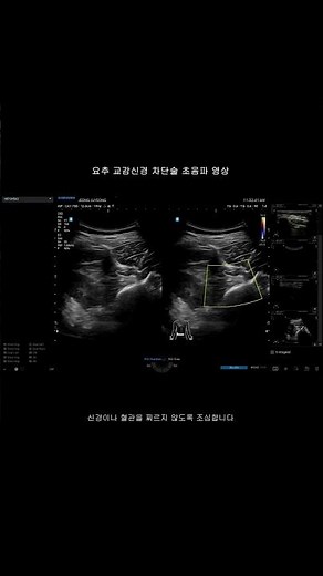 Ultrasound-Guided Lumbar Sympathetic Nerve Block #short #PainMedicine #PDRNInjection #GangnamYons...