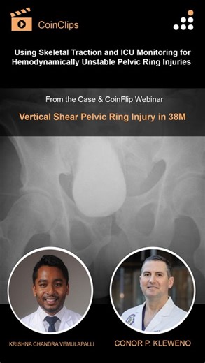 Orthobullets on Instagram: "Here is a clip from our latest episode of CoinFlips & Controversies, “Vertical Shear Pelvic Ring Injury in 38M.” Watch Drs. @kcvemu6 & Kleweno, discuss “Using Skeletal Traction and ICU Monitoring for Hemodynamically Unstable Pelvic Ring Injuries”. Click the Link in Bio to learn more and watch their full webinar on Orthobullets."