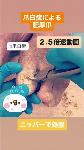 Thickened nails due to onychomycosis
