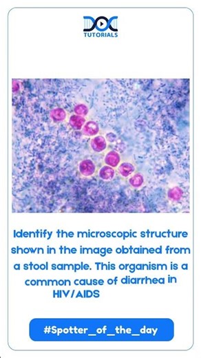 Can You Identify the Pathogen in HIV-related Diarrhea? Test Your Knowledge Now!