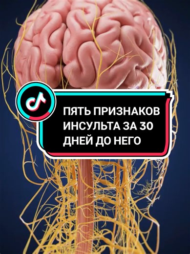 Пять признаков инсульта за 30 дней до него