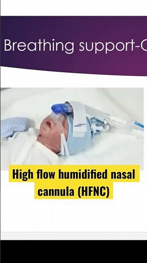 Baby on high flow humidified nasal cannula (HFNC) #nicu #neonatal #neonatology #ventilation #HFNC