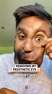 Removing my prosthetic eye 👁️😧 #prosthetic #neurofibromatosis #prostheticeye | Happiest