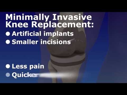 Minimally invasive knee replacement - Arthroplasty
