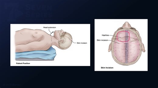 #449: Anterior Interhemispheric Approach for Resection of a Paramedian Frontal Arteriovenous Malformation - All Videos - Seven Series Collection