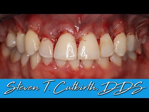 How to Suture a Crown Lengthening Surgery - Dental Minute with Steven T. Cutbirth, DDS