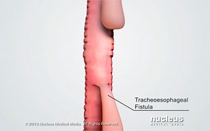 视频：食管气管瘘（Tracheoesophageal fistula Repair）