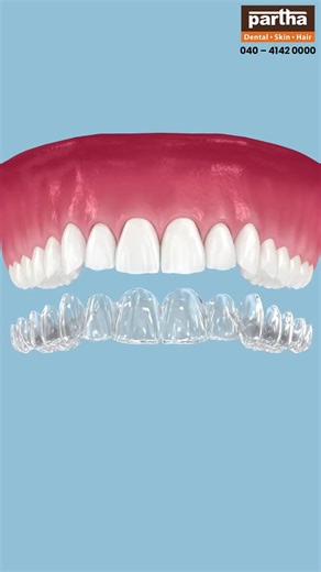 Ever wondered why Invisalign comes with a premium price tag? 🤔 It’s about much more than just clear plastic! From advanced 3D scanning to 100% customized treatment plans, every step is designed for precision, comfort, and faster results. You aren't just paying for aligners; you’re investing in a predictable journey to your perfect smile. ✨ Visit Partha Dental to start your digital smile transformation today! 🦷💻 Why Choose Partha Dental Clinic? •Experienced Doctors •Super Specialists •Quality 