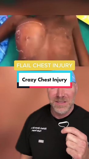 This is a pretty severe injury and requires immediate chest tube placement and care. #trauma #surgery #surgeon #chest