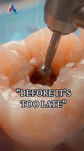 What Happens When Tooth Decay Hits The Nerve? Root Canal Procedure Explained