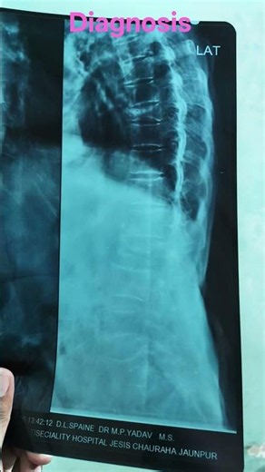 DL Spine X-Ray | Dorsolumbar Spine AP & Lateral View